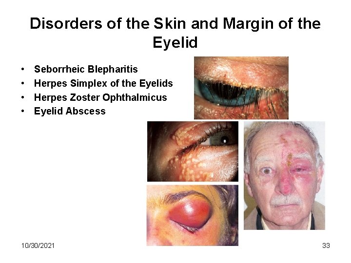 Disorders of the Skin and Margin of the Eyelid • • Seborrheic Blepharitis Herpes