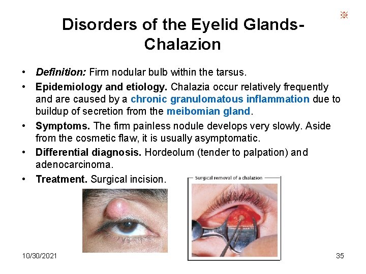Disorders of the Eyelid Glands. Chalazion ※ • Definition: Firm nodular bulb within the