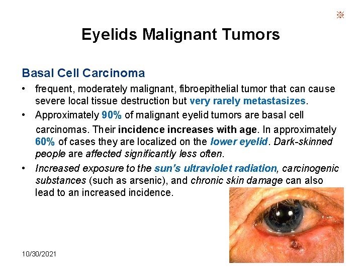 ※ Eyelids Malignant Tumors Basal Cell Carcinoma • frequent, moderately malignant, fibroepithelial tumor that