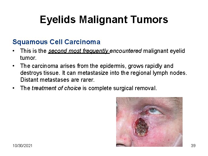Eyelids Malignant Tumors Squamous Cell Carcinoma • This is the second most frequently encountered