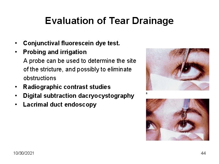 Evaluation of Tear Drainage • Conjunctival fluorescein dye test. • Probing and irrigation A
