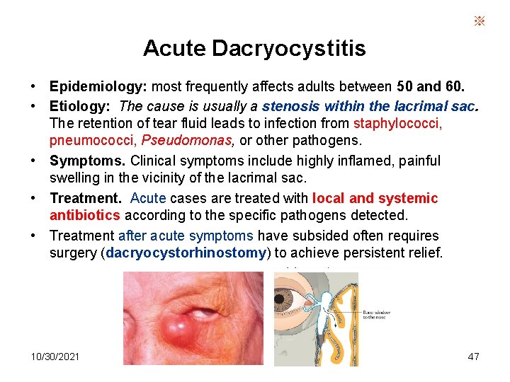 ※ Acute Dacryocystitis • Epidemiology: most frequently affects adults between 50 and 60. •