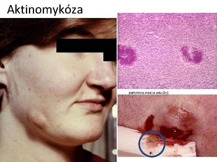 Aktinomykóza pathmicro. med. sc. edu (3×) 