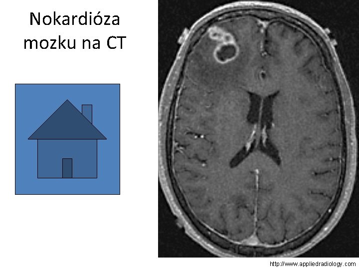 Nokardióza mozku na CT http: //www. appliedradiology. com 