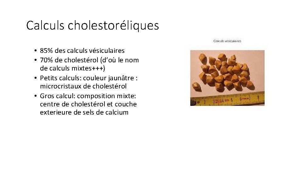 Calculs cholestoréliques • 85% des calculs vésiculaires • 70% de cholestérol (d’où le nom