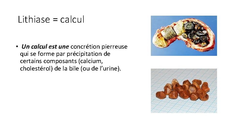 Lithiase = calcul • Un calcul est une concrétion pierreuse qui se forme par