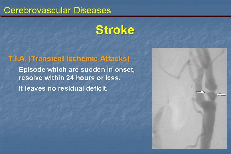 Cerebrovascular Diseases Stroke T. I. A. (Transient Ischemic Attacks) - Episode which are sudden