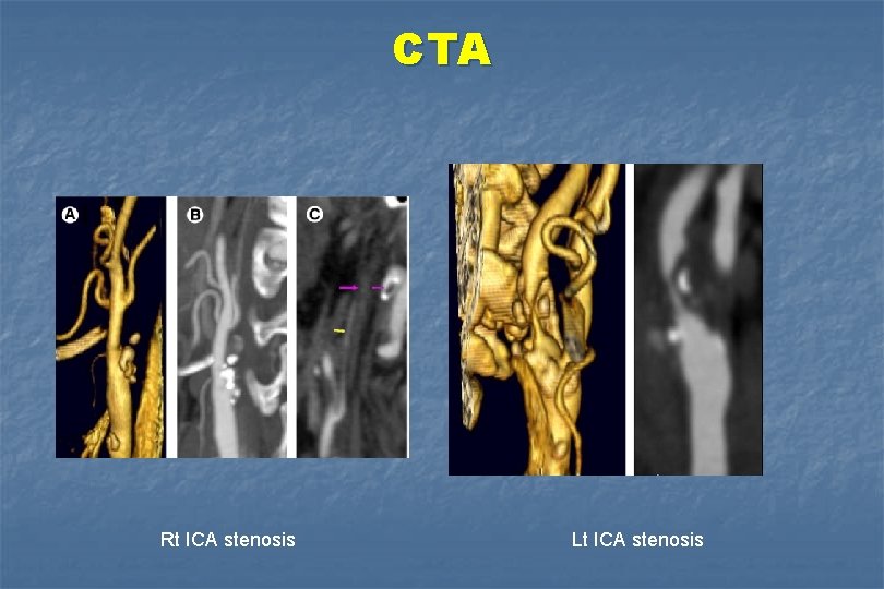 CTA Rt ICA stenosis Lt ICA stenosis 