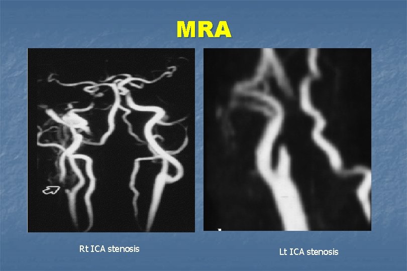 MRA Rt ICA stenosis Lt ICA stenosis 