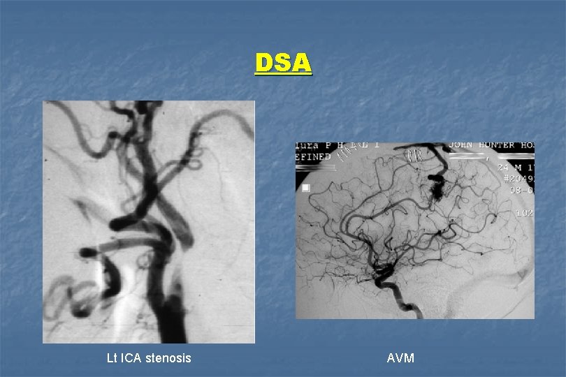 DSA Lt ICA stenosis AVM 