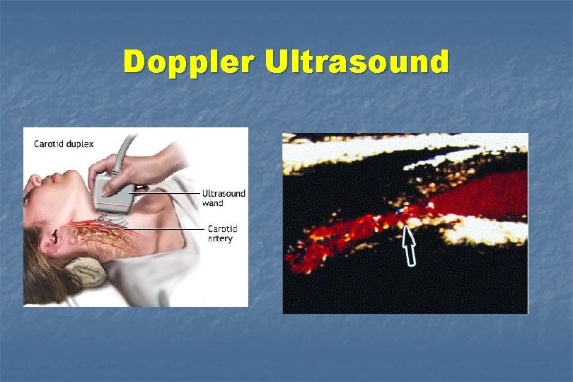 Doppler Ultrasound 