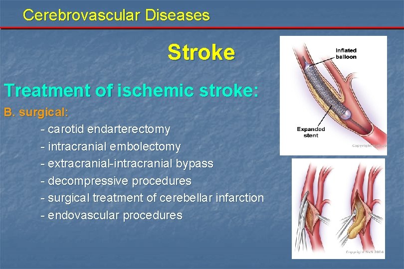 Cerebrovascular Diseases Stroke Treatment of ischemic stroke: B. surgical: - carotid endarterectomy - intracranial