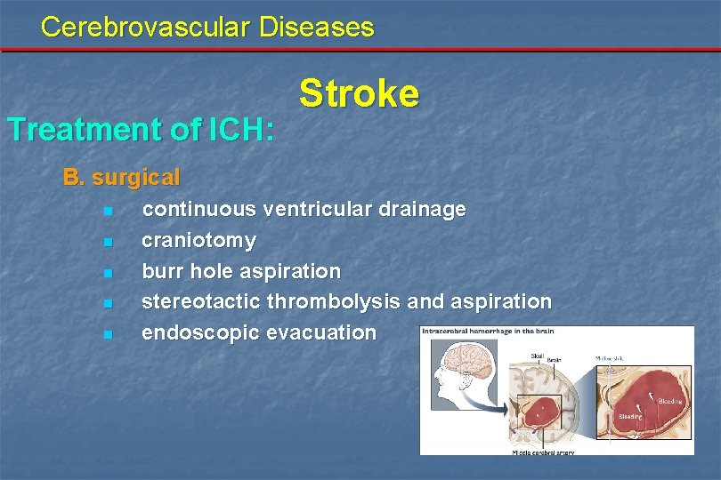 Cerebrovascular Diseases Treatment of ICH: Stroke B. surgical n n n continuous ventricular drainage