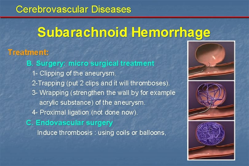 Cerebrovascular Diseases Subarachnoid Hemorrhage Treatment: B. Surgery: micro surgical treatment 1 - Clipping of
