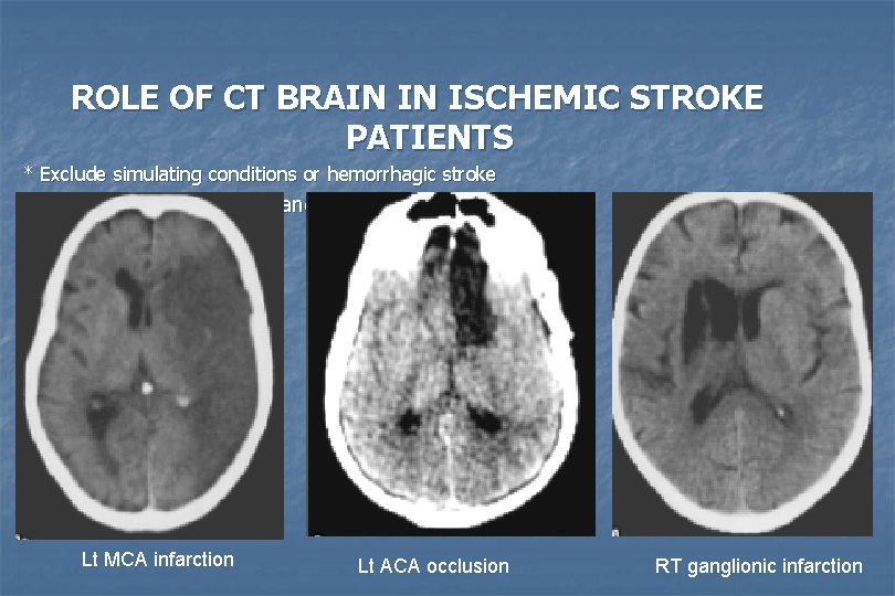 ROLE OF CT BRAIN IN ISCHEMIC STROKE PATIENTS * Exclude simulating conditions or hemorrhagic