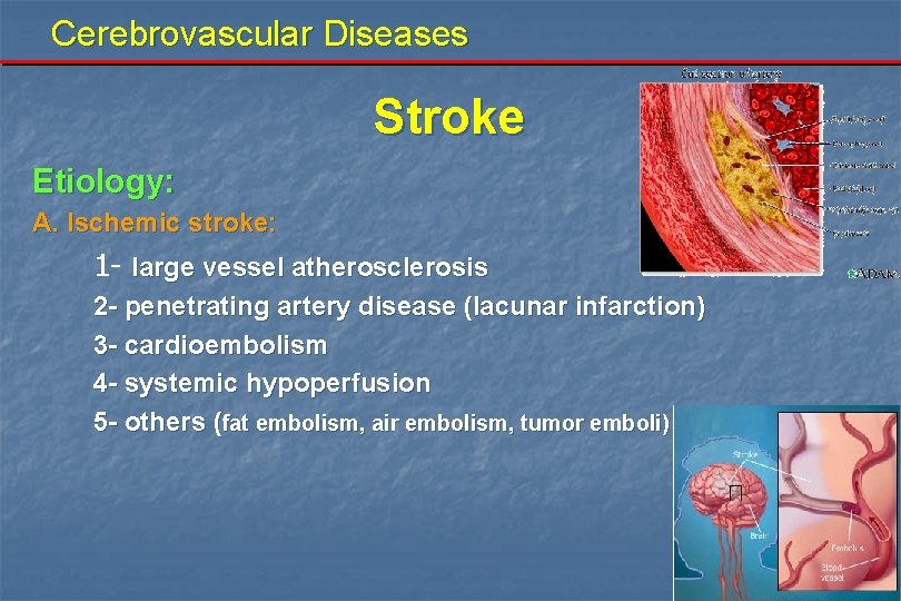 Cerebrovascular Diseases Stroke Etiology: A. Ischemic stroke: 1 - large vessel atherosclerosis 2 -