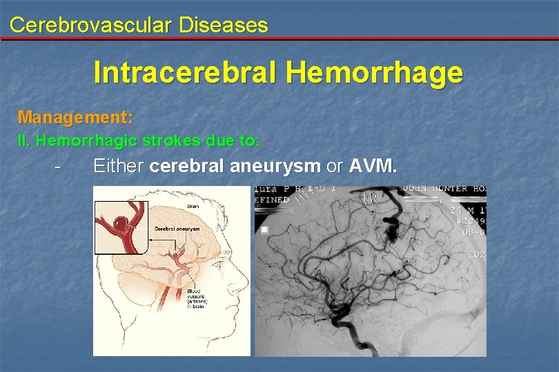 Cerebrovascular Diseases Intracerebral Hemorrhage Management: II. Hemorrhagic strokes due to: - Either cerebral aneurysm