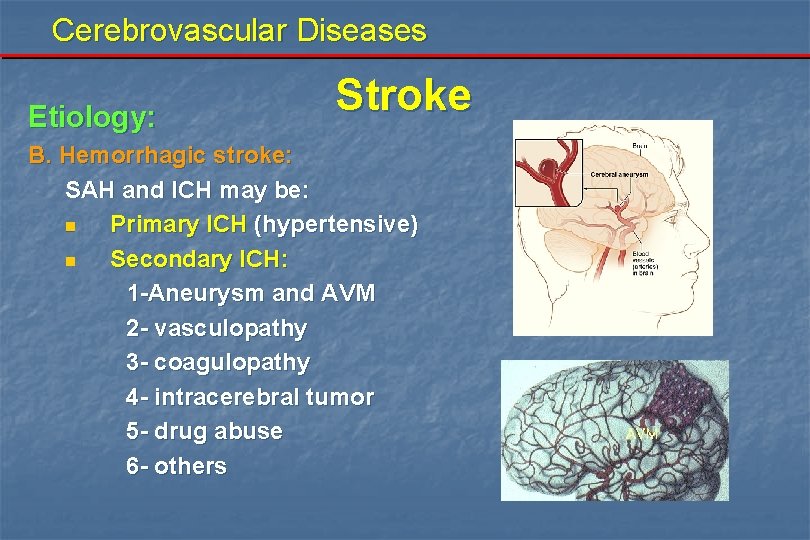 Cerebrovascular Diseases Etiology: Stroke B. Hemorrhagic stroke: SAH and ICH may be: n Primary
