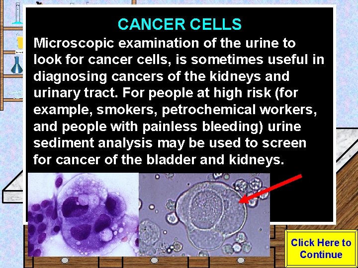 CANCER CELLS Urine Sample Microscopic examination of the urine to look for cancer cells,