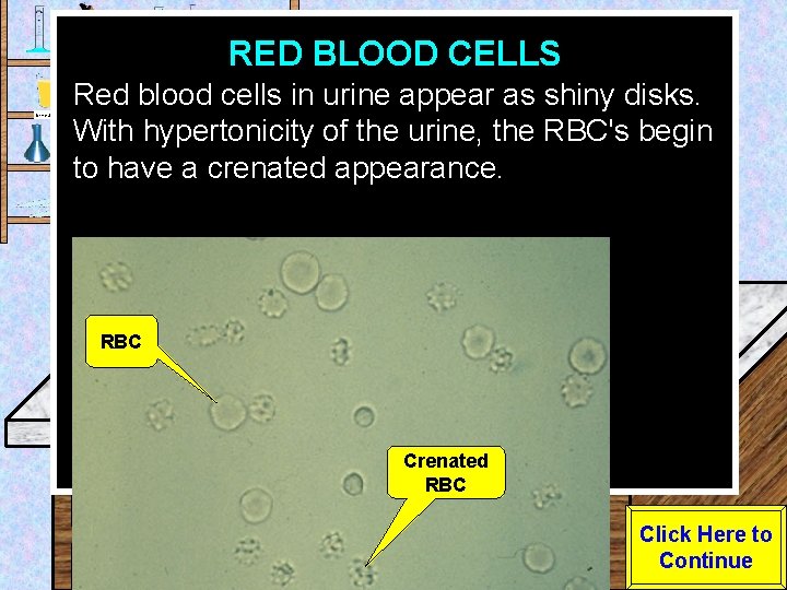RED BLOOD CELLS Urine Sample Red blood cells in urine appear as shiny disks.