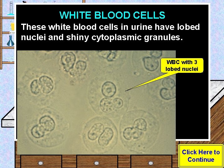 WHITE BLOOD CELLS Urine Sample These white blood cells in urine have lobed nuclei