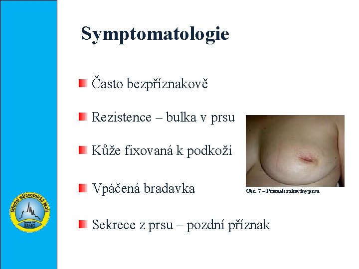 Symptomatologie Často bezpříznakově Rezistence – bulka v prsu Kůže fixovaná k podkoží Vpáčená bradavka