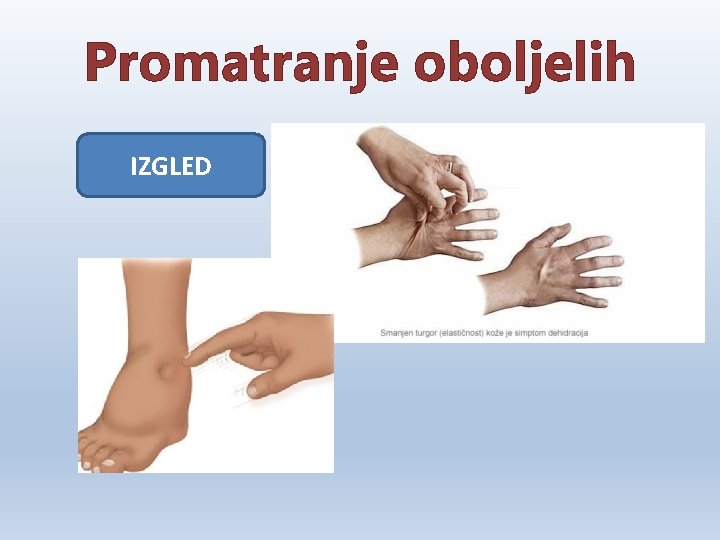 Promatranje oboljelih IZGLED 