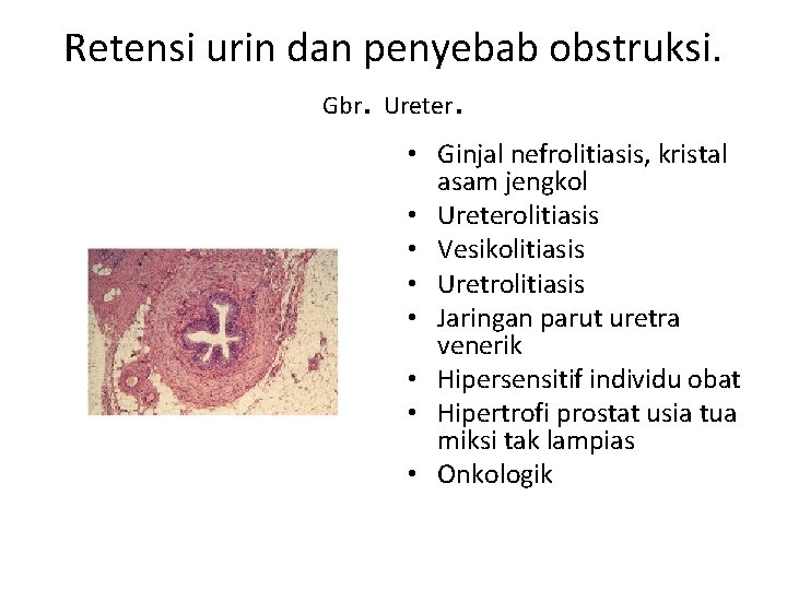 Retensi urin dan penyebab obstruksi. Gbr. Ureter. • Ginjal nefrolitiasis, kristal asam jengkol •