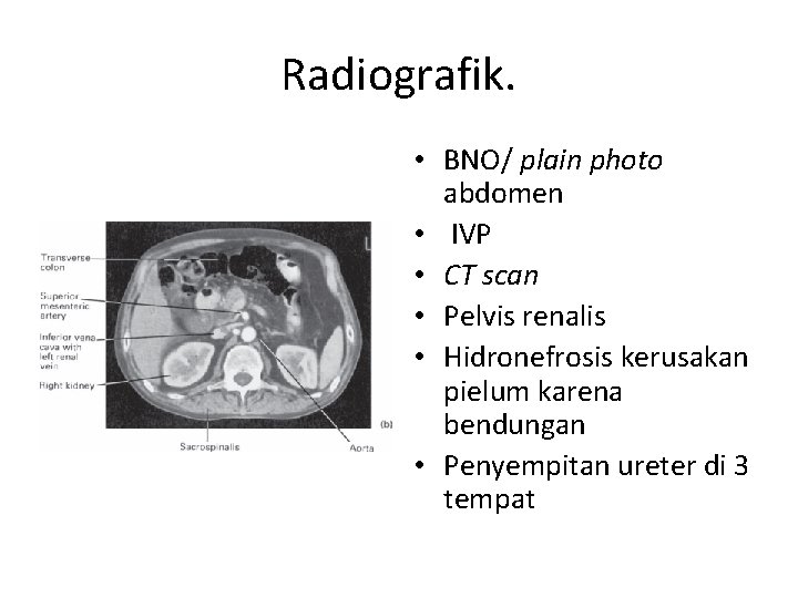 Radiografik. • BNO/ plain photo abdomen • IVP • CT scan • Pelvis renalis