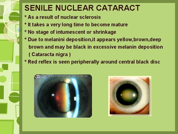 SENILE NUCLEAR CATARACT * As a result of nuclear sclerosis * It takes a