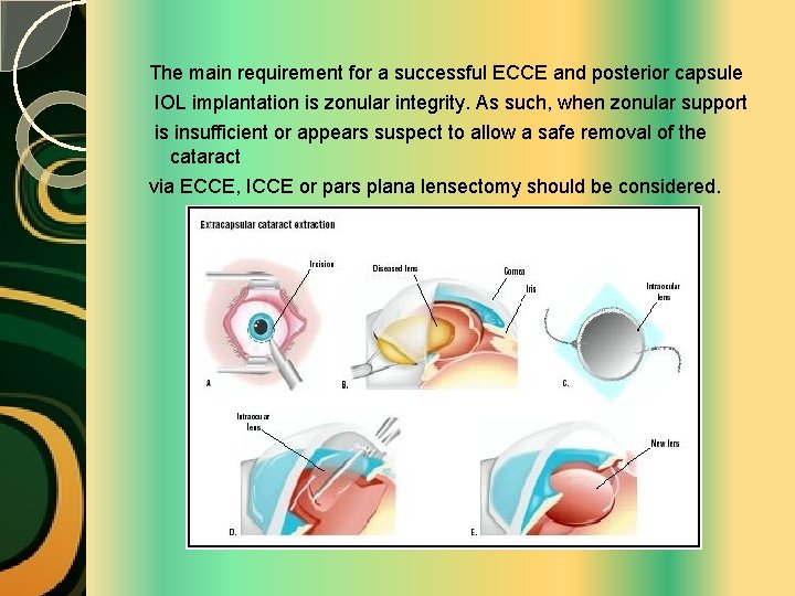 The main requirement for a successful ECCE and posterior capsule IOL implantation is zonular
