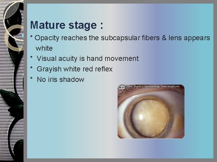 Mature stage : * Opacity reaches the subcapsular fibers & lens appears white *