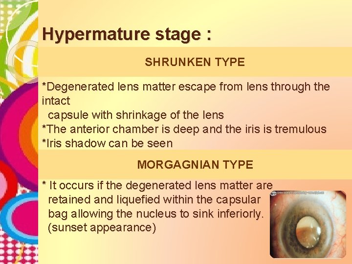 Hypermature stage : SHRUNKEN TYPE *Degenerated lens matter escape from lens through the intact