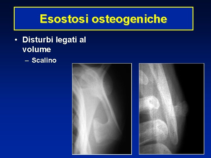 Esostosi osteogeniche • Disturbi legati al volume – Scalino 