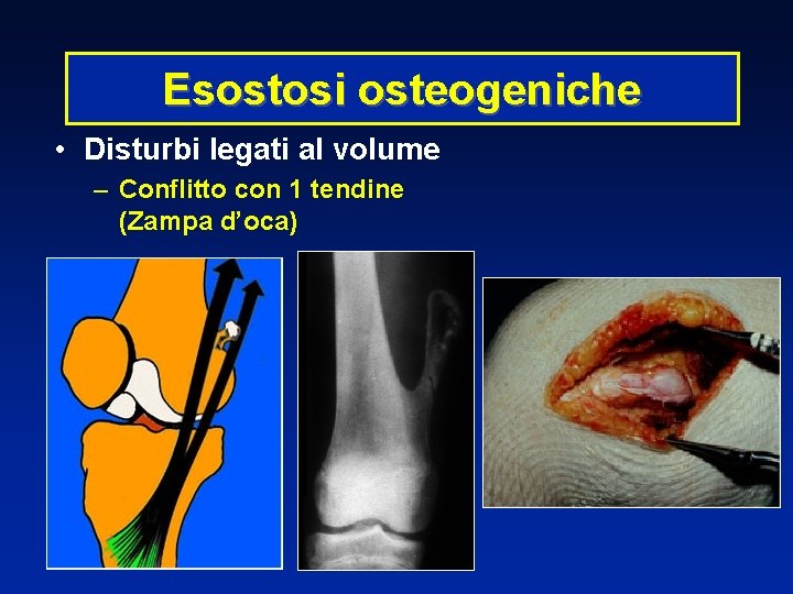 Esostosi osteogeniche • Disturbi legati al volume – Conflitto con 1 tendine (Zampa d’oca)