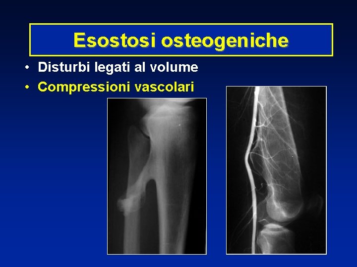 Esostosi osteogeniche • Disturbi legati al volume • Compressioni vascolari 