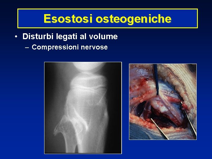 Esostosi osteogeniche • Disturbi legati al volume – Compressioni nervose 