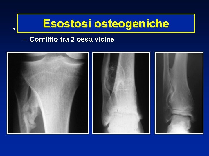 • Esostosi osteogeniche Gêne liée au volume – Conflitto tra 2 ossa vicine