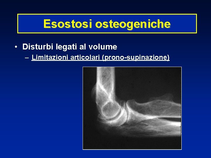 Esostosi osteogeniche • Disturbi legati al volume – Limitazioni articolari (prono-supinazione) 