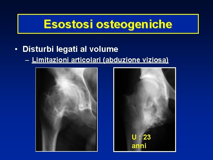 Esostosi osteogeniche • Disturbi legati al volume – Limitazioni articolari (abduzione viziosa) U :