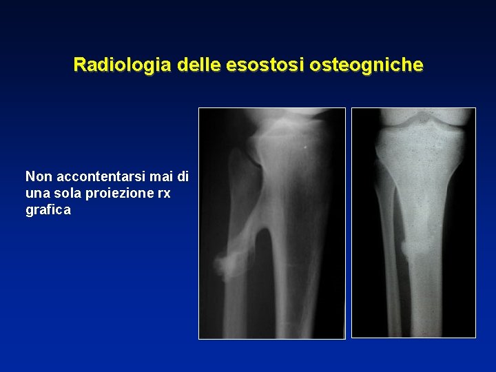 Radiologia delle esostosi osteogniche Non accontentarsi mai di una sola proiezione rx grafica 