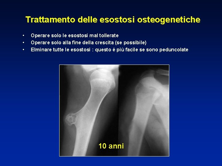 Trattamento delle esostosi osteogenetiche • • • Operare solo le esostosi mal tollerate Operare
