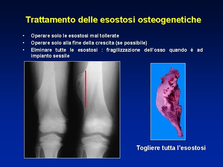 Trattamento delle esostosi osteogenetiche • • • Operare solo le esostosi mal tollerate Operare