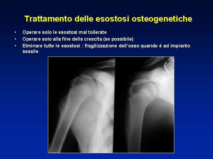 Trattamento delle esostosi osteogenetiche • • • Operare solo le esostosi mal tollerate Operare