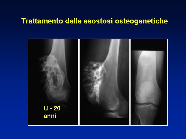 Trattamento delle esostosi osteogenetiche U - 20 anni 