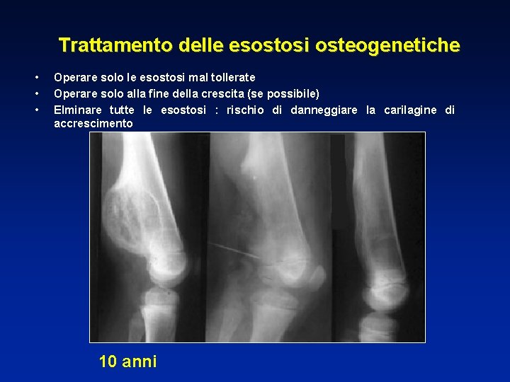 Trattamento delle esostosi osteogenetiche • • • Operare solo le esostosi mal tollerate Operare