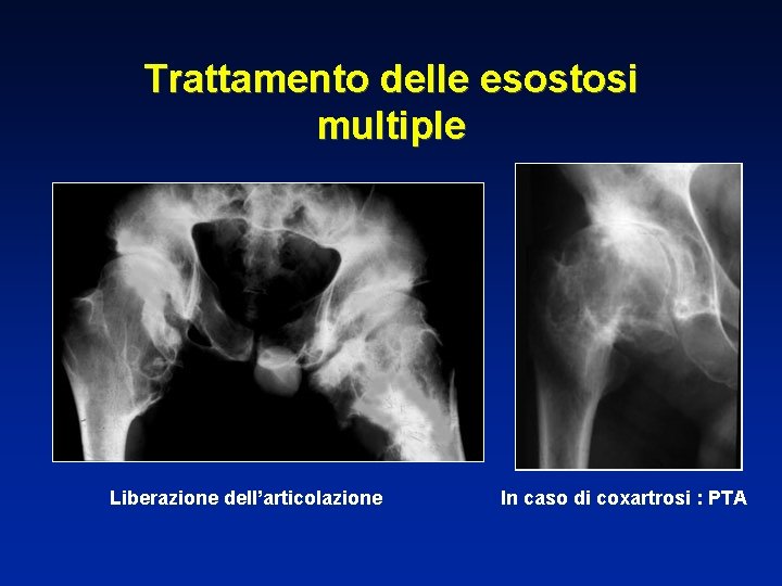 Trattamento delle esostosi multiple Liberazione dell’articolazione In caso di coxartrosi : PTA 