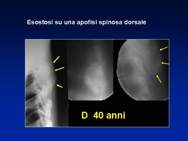 Esostosi su una apofisi spinosa dorsale D 40 anni 