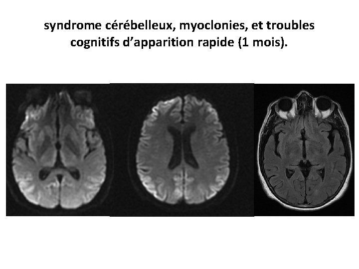 syndrome cérébelleux, myoclonies, et troubles cognitifs d’apparition rapide (1 mois). 