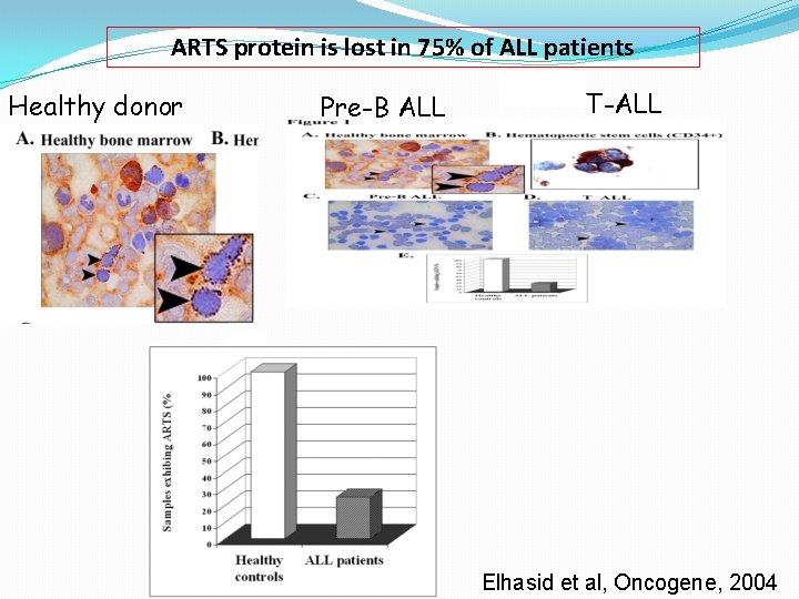 ARTS protein is lost in 75% of ALL patients Healthy donor Pre-B ALL T-ALL